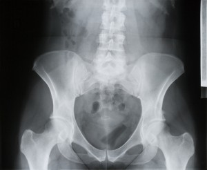 Radiographie du bassin avec le squelette, utile pour un ostéopathe